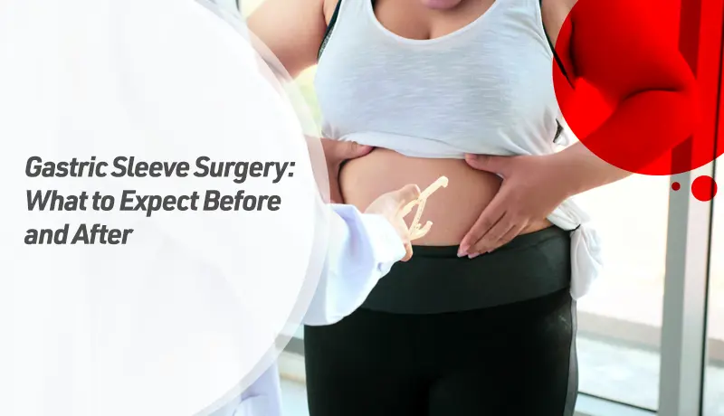 Gastric Sleeve Surgery: What to Expect Before and After