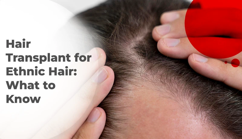 Hair Transplant for Ethnic Hair: What to Know