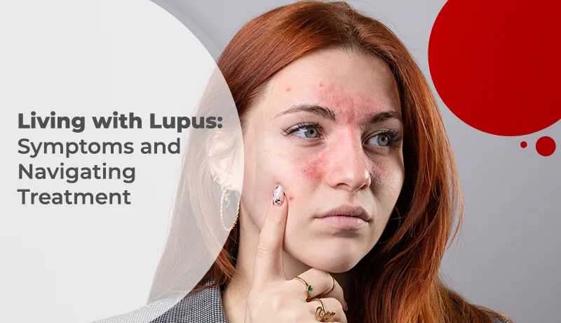 Living with Lupus: Symptoms and Navigating Treatment