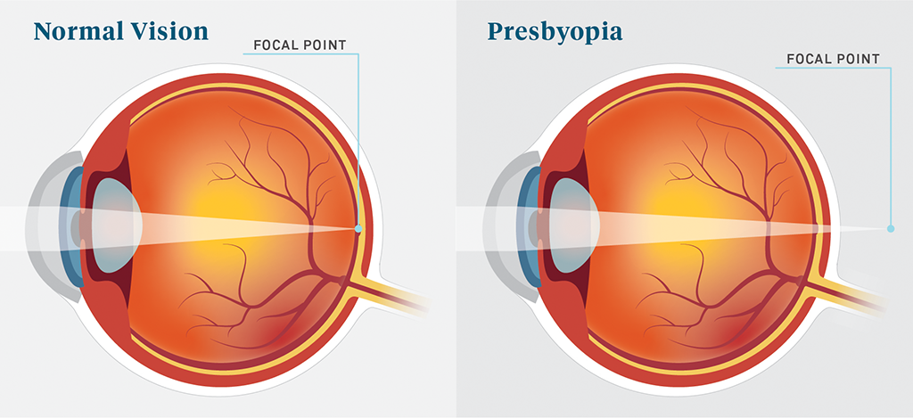 Ekolgöz / Presbyopia